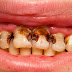 Nguyên nhân sâu răng chủ yếu