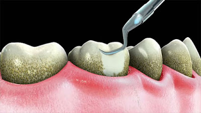 Tìm hiểu về phương pháp cạo vôi răng