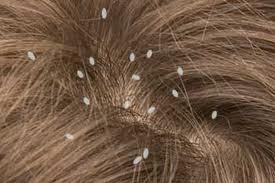 what lice look like