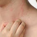 Best Tips and Skin Allergy (Eczema) Fighter Foods 