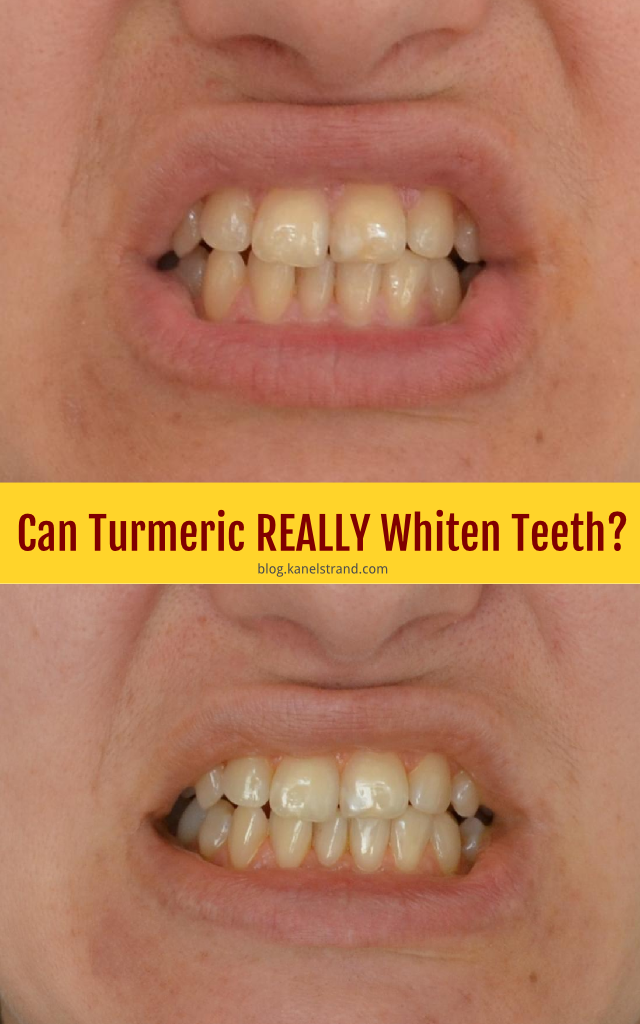Really Yellow Teeth Kanelstrand: can turmeric really whiten teeth?