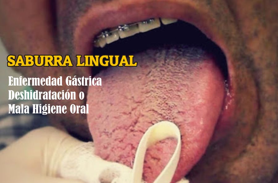 conjunción ducha bofetada SABURRA LINGUAL: ¿Cómo eliminar esa capa blanca sobre mi lengua? -  OdontoFarma