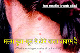 मस्सा छुवा-छूत से होने वाला वायरस है Wart is contagiousness virus in hindi, मस्सा एक तरह से स्किन डिजीज होता है a wart is a skin disease in hindi, मस्सों के लिए घरेलू उपाय home remedies for warts in hindi, मस्से  की आयुर्वेदिक दवा केला wart ayurvedic medicine banana in hindi, मस्से के लिए लहसुन उपयोगी garlic useful for warts in hindi, मस्से  को हटाने  लिए सेब का सिरका apple cider vinegar to remove warts in hindi, आलू से मस्से  को  दूर हो सकते है potato can remove warts in hindi, मस्से  के लिए बेकिंग सोडा फायदेमंद baking soda beneficial for warts in hindi, अनानास से मस्से दूर हो सकते है warts can be removed from pineapple in hindi, बरगद से मस्से  दूर हो सकते है banyan can remove warts in hindi, घरेलू उपाय द्वारा दूर हो सकते हैं मस्से warts can be removed by home remedy in hindi, मस्से  दूर करने के लिए सलिसिलिक अम्ल salicylic acid for warts removal in hindi, मस्से  दूर करने के लिए कोथमीर kothmir to remove warts in hindi, मस्से  दूर करने के लिए अरंडी का तेल castor oil to remove warts in hindi, मस्से  दूर करने के लिए मौसमी sweet Lemon to remove warts in hindi, मस्से  दूर करने के लिए अम्लाकी amalaki to remove warts in hindi, मस्से  दूर करने के लिए कासीसादि तेल cassiadi oil to remove warts in hindi, मस्से  दूर करने के लिए पपीता papaya for wart removal in hindi, मस्से दूर करने के लिए एलोवेरा aloe vera to remove warts in hindi, मस्से  दूर करने के लिए फ्लॉस बांधना tying floss to remove warts in hindi, मस्से  दूर करने के लिए अलसी flaxseed to remove warts in hindi, मस्से  दूर करने के लिए गर्म पानी hot water to remove warts in hindi, मस्सा की संभावना कैसे how is wart possibility in hindi, मस्सा से कैसे बचे how to escape wart in hindi, आहार मस्सों से बचा सकता है diet can prevent warts in hindi, a wart is a skin disease, home remedies for warts, wart ayurvedic medicine banana, garlic useful for warts, apple cider vinegar to remove warts, potatoes remove wart, baking soda for warts, pineapple removes warts, warts can be removed by home remedy, salicylic acid for warts removal, kothmir to remove warts, castor oil to remove warts, how is wart possibility, how to escape warts, ayurveda Lifestyle keep away from diseases in hindi, masse ka ilaj in hindi, masse ka gharelu upchar hindi, masse ki dawa, masse ki ayurvedic medicine at hime in hindi, sakshambano, sakshambano ka uddeshya, latest viral post of sakshambano website, sakshambano pdf hindi,