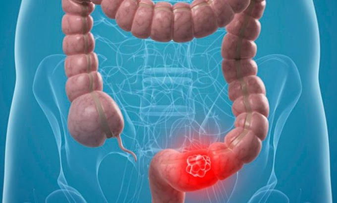 Το όσπριο που προστατεύει από καρκίνο του παχέος εντέρου