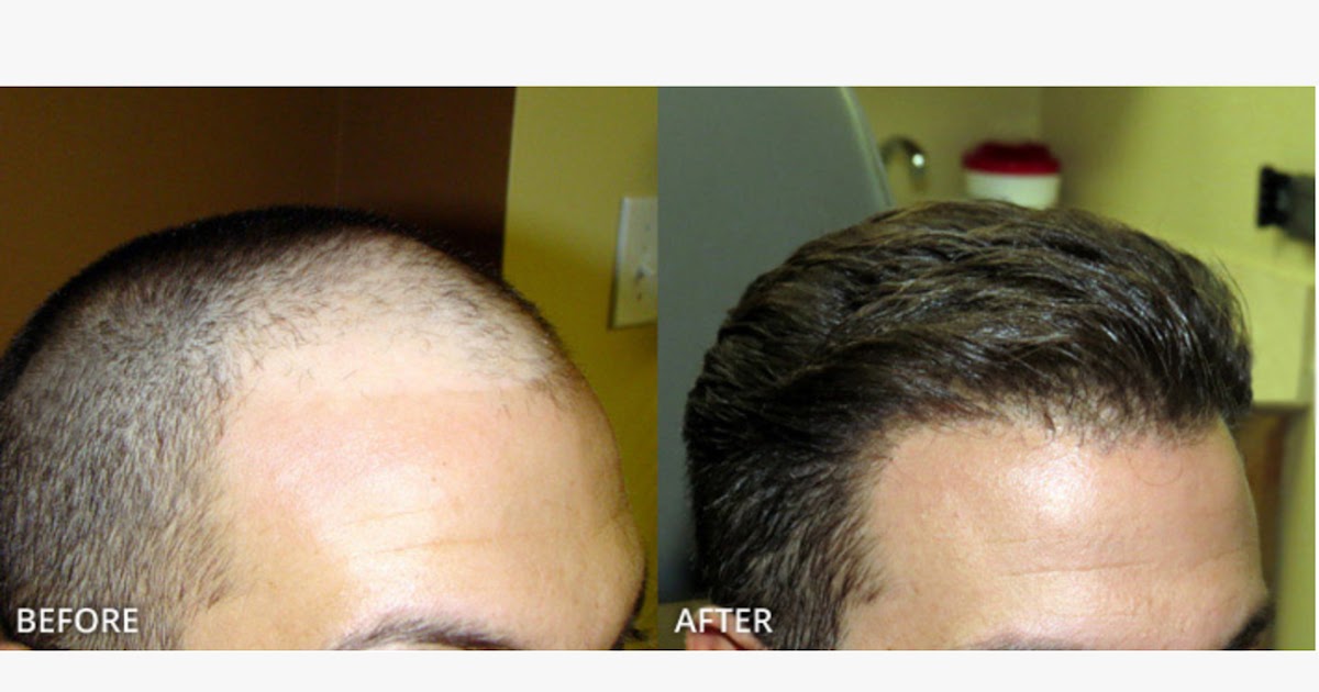 scalp hair transplant treatment