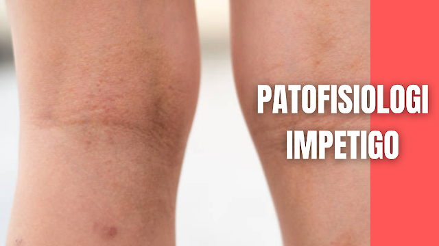 Patofisiologi Impetigo Krustosa