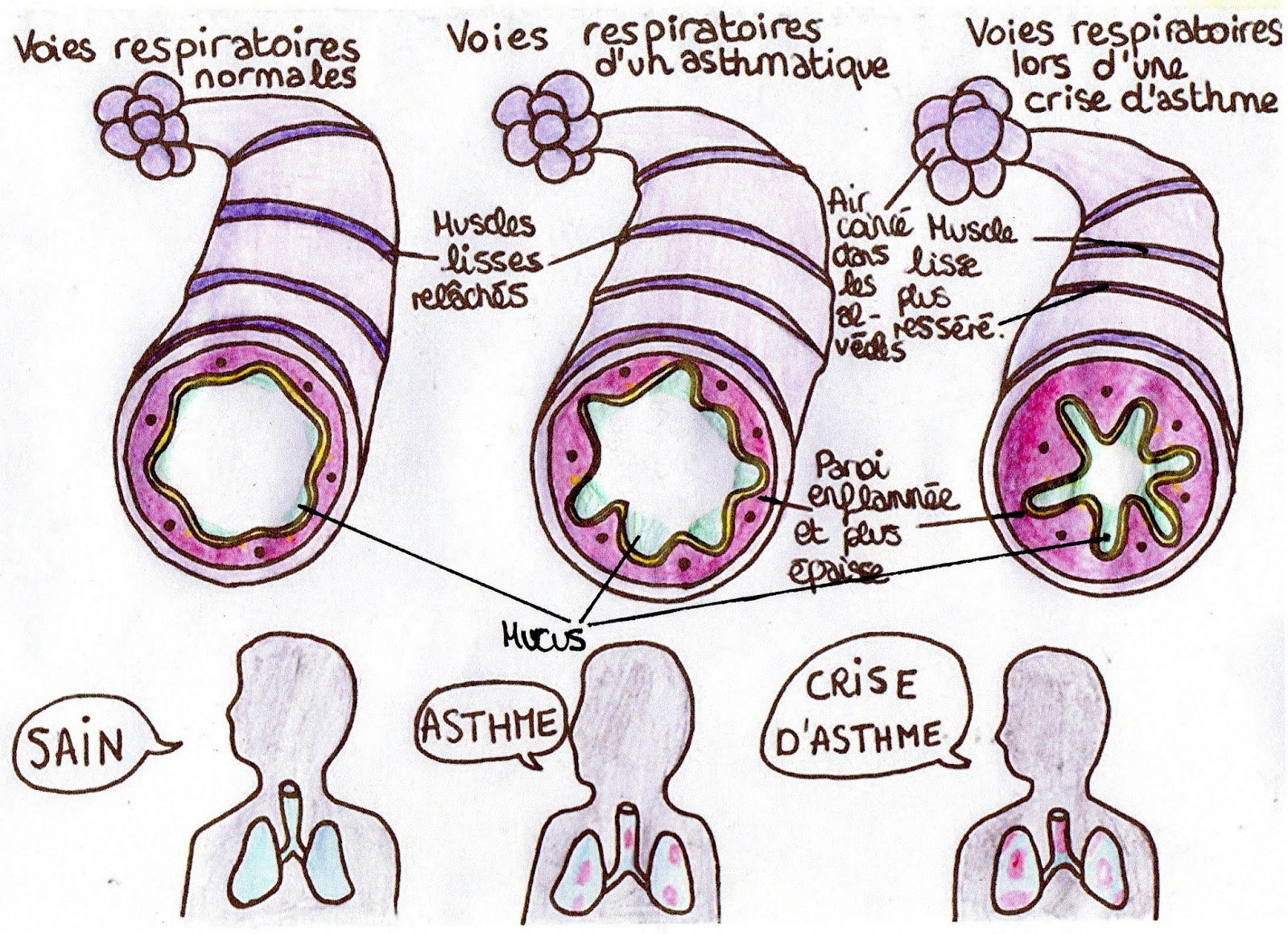L'asthme de A à E: La crise d'asthme: aspect macroscopique