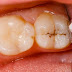 Răng cấm bị sâu có nên nhổ