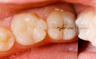 Răng cấm bị sâu có nên nhổ-1