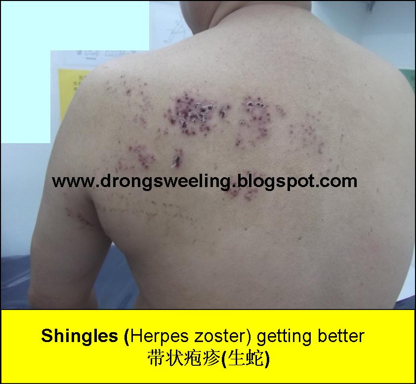 TCM News TCM Physician Cure Shingles (Herpes Zoster), Postherpetic Neuralgia 带状疱疹(生蛇)