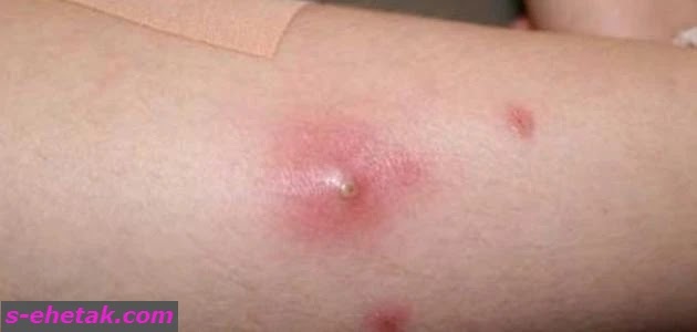 أسباب الخراج في المناطق الحساسة أسباب الخراج في المناطق الحساسة