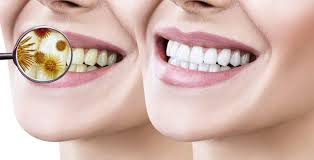 teeth whitening business