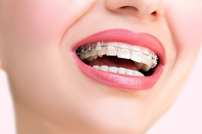 Giải thích niềng răng có ảnh hưởng đến sức khoẻ không 1