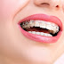 Giải thích niềng răng có ảnh hưởng đến sức khoẻ không