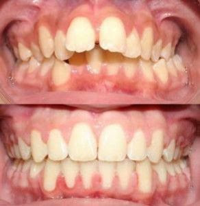 Điều chỉnh răng hô móm