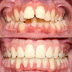 Điều chỉnh răng hô móm như thế nào?