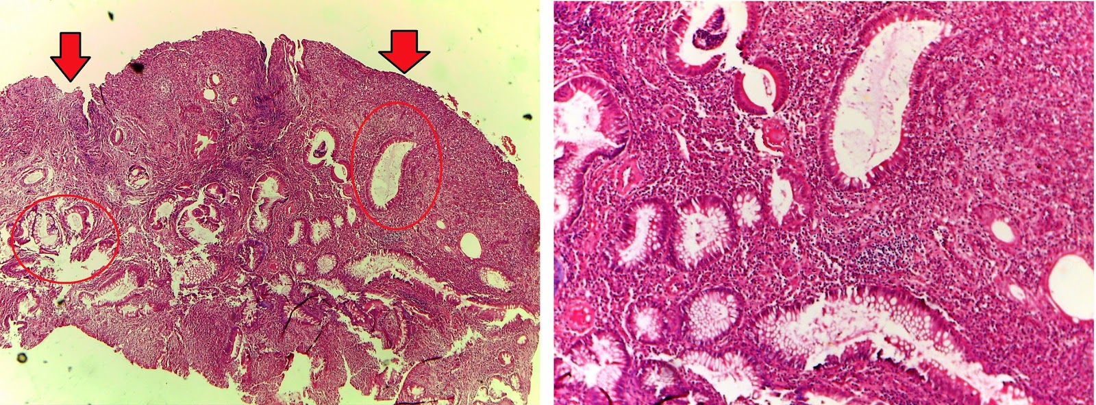 Gastrointestinal And Liver Histology Pathology Atlas Colon Inflammatory Polyp Aka Pseudopolyp