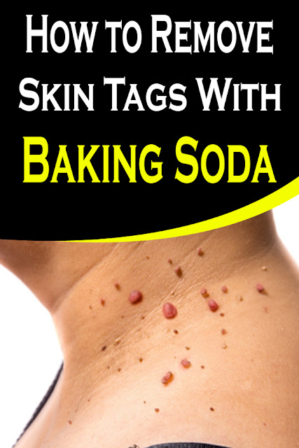 Does Castor Oil Remove Skin Tags How to Remove Skin Tags With Baking Soda and Castor Oil - evantrybeauty