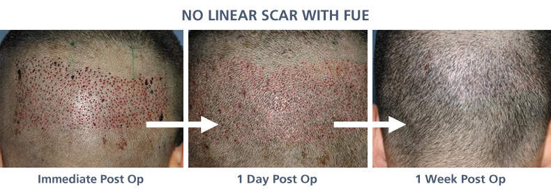 Hair Loss Treatment: Follicular Unit Extraction
