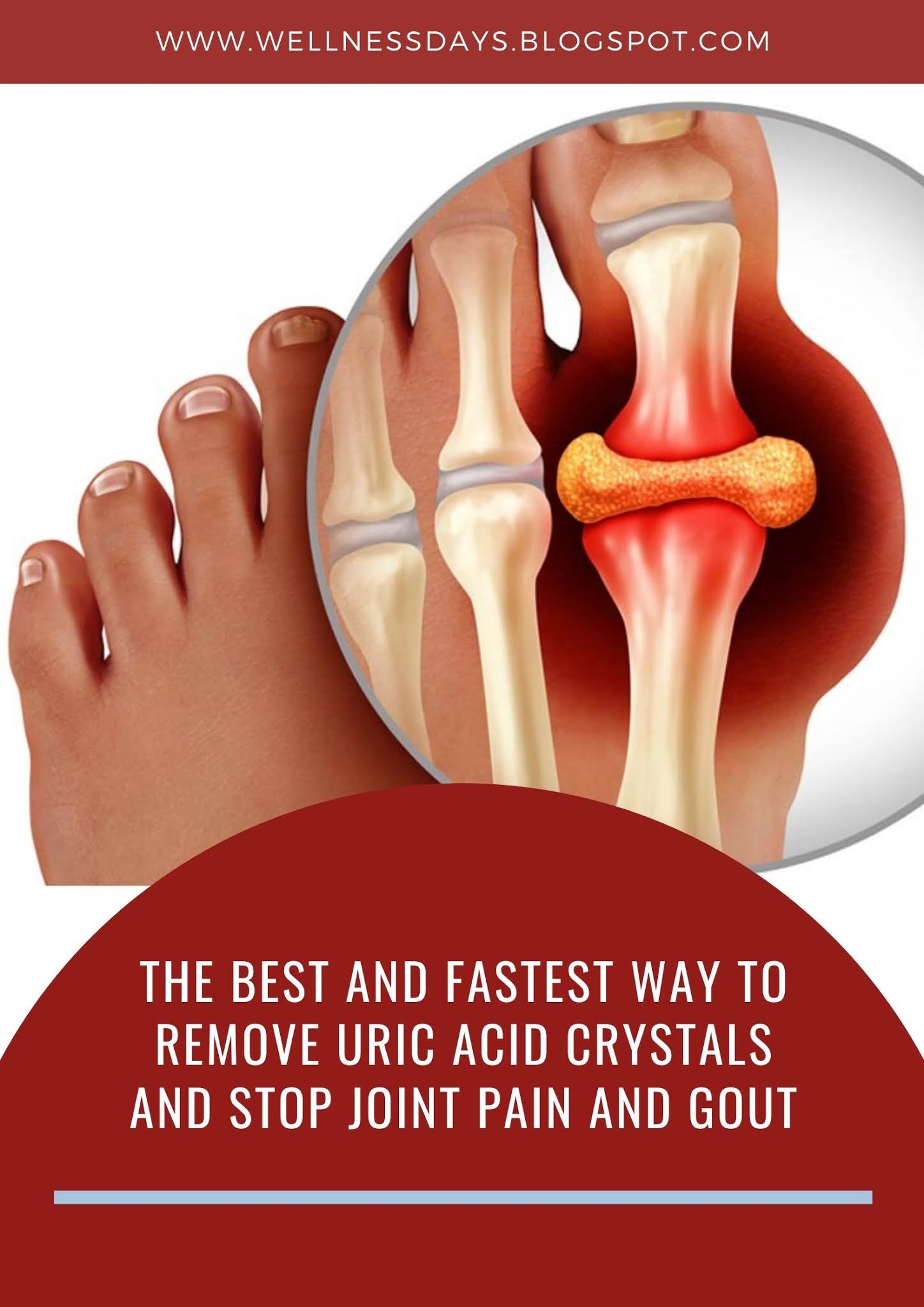 The Best And Fastest Way To Remove Uric Acid Crystals And Stop Joint