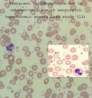 Case study (12)- Transient thrombocytosis due to unknown origin with macrocytic hypochromic anemia.