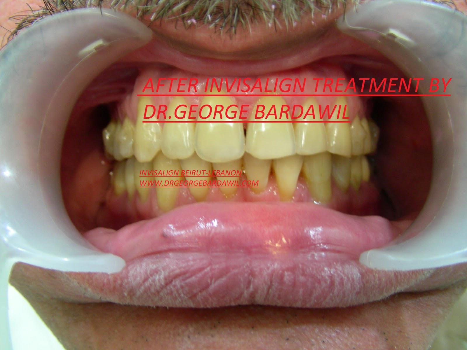 E. BardawilOrthodontistInvisalign Diamond level