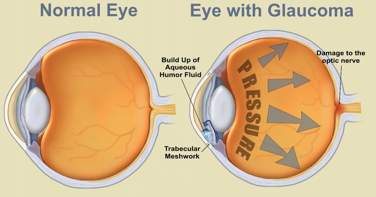 Whether to treat Ocular Hypertension and suspect or not to