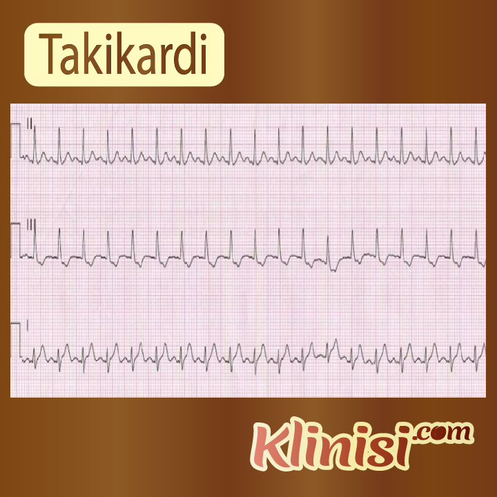 Takikardi Penyakit Kardiovaskuler