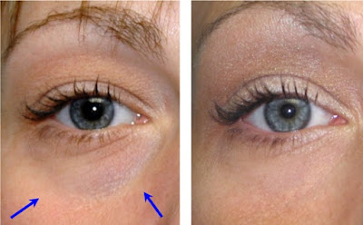 eyelid surgery before and after picture