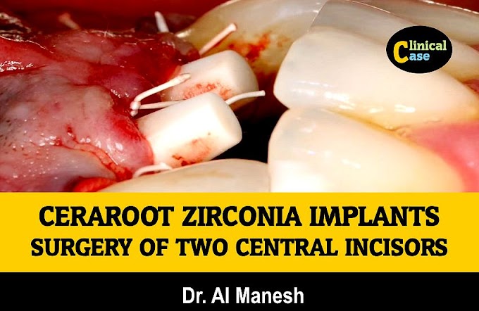 CERAROOT ZIRCONIA IMPLANTS: Surgery of two central incisors - Dr. Al Manesh