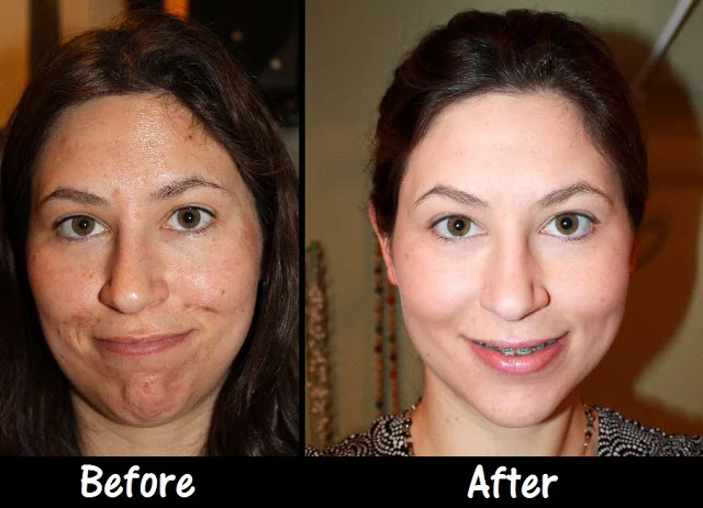 Chemical Peel Before and After