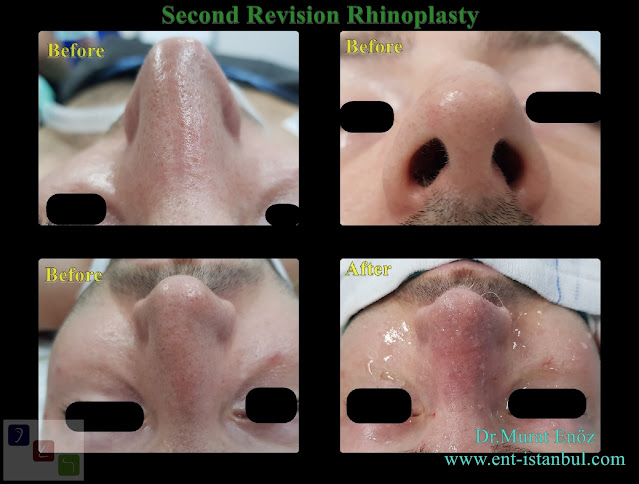 Secondary nose job istanbul,2nd Revision Male Rhinoplasty,revision nose aesthetic surgery,