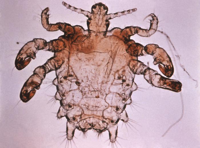 Fordyce Spots: crabs std | Fordyce Spots Treatment ...