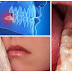 Nhổ răng khôn có ảnh hưởng gì không? Nha khoa nào uy tín?