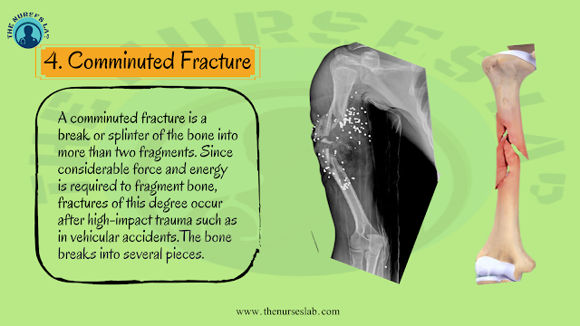 Types of Bone Fracture