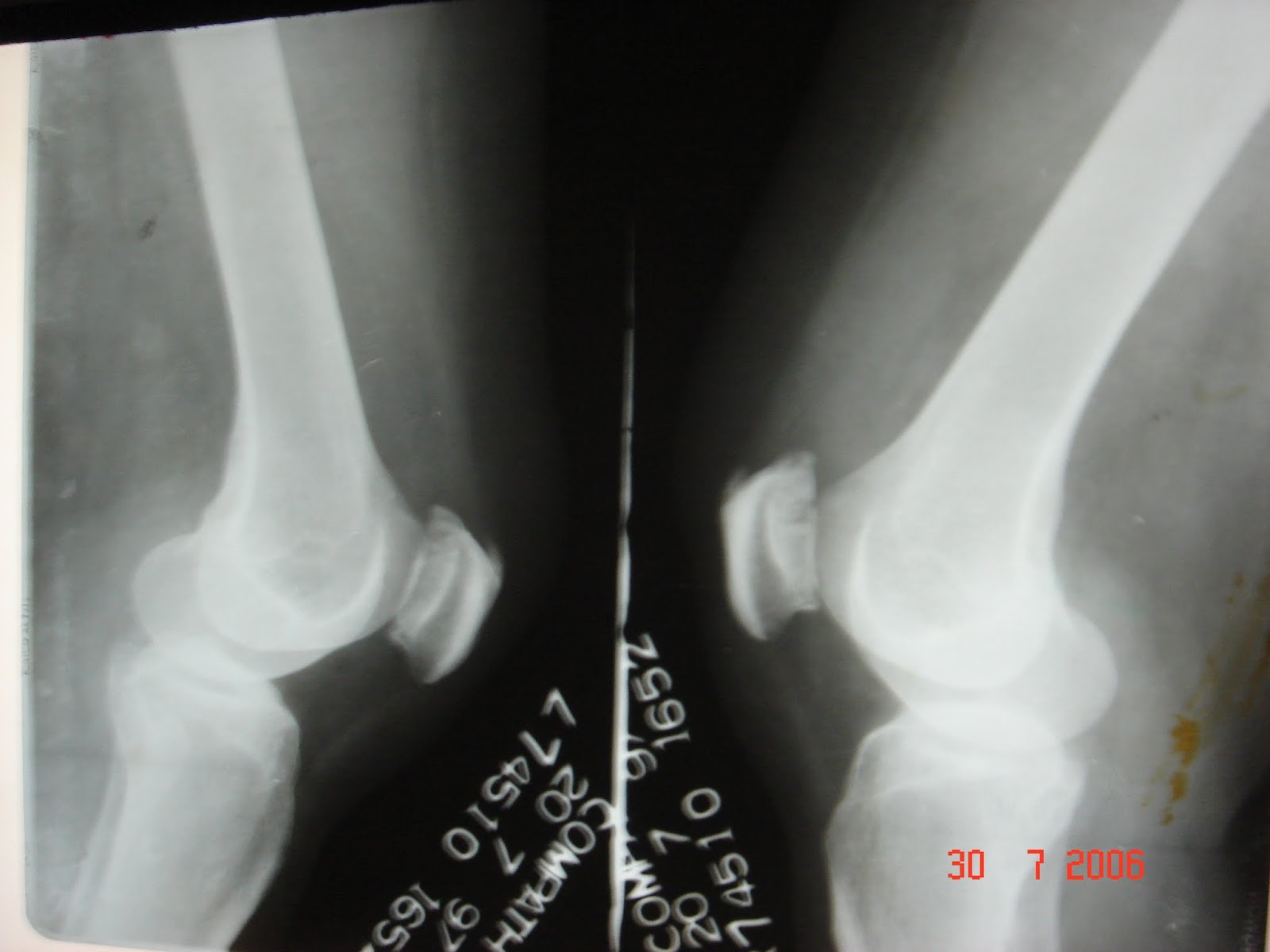 Xrays and Slides chondromalacia patella
