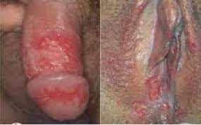 Gambar Penyakit Gonorrhea & Chlamydia