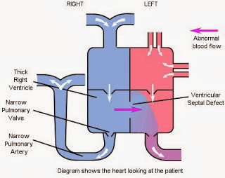 Pathophysiology of Tetralogy of Fallot - Nanda Care Plan