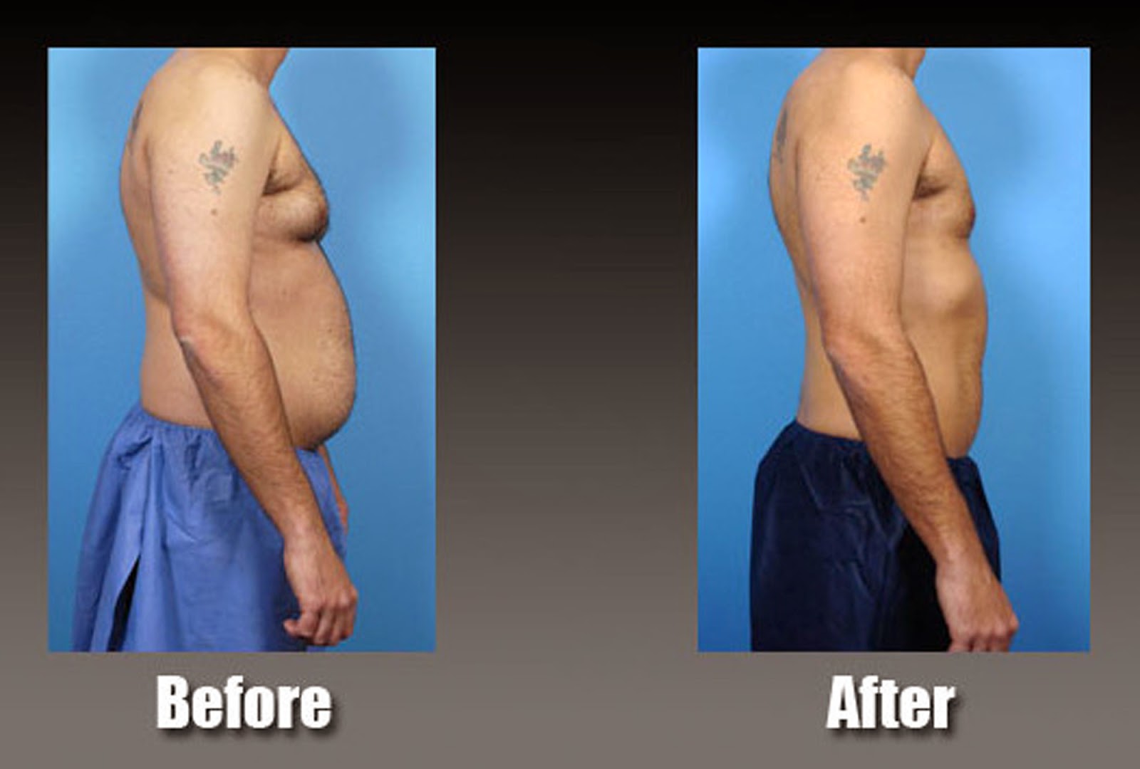 Liposuction Las Vegas