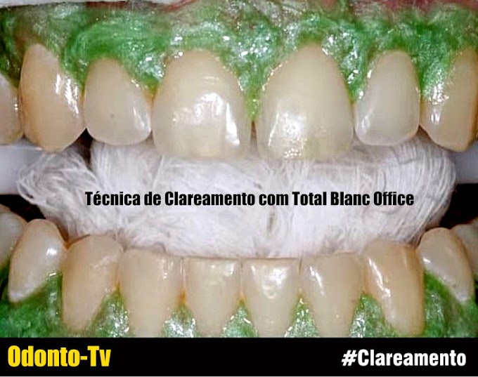 CLAREAMENTO: Técnica com Total Blanc Office - Nova DFL