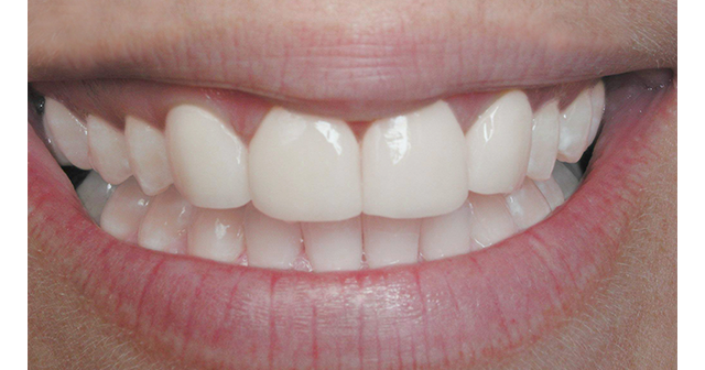 Whiten Teeth In Photoshop | Photoshop Tutorials