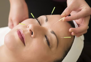 akupunktur tedavi yöntemleri