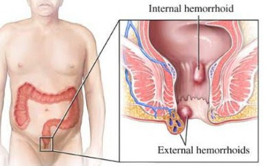 manfaat minum rebusan daun sirsak efek samping daun sirsak terhadap kesuburan, cara merebus daun sirsak untuk kolesterol, cara merebus daun sirsak untuk asam urat, cara merebus daun sirsak untuk diabetes, manfaat daun sirsak untuk tumor, cara mengolah daun sirsak untuk obat jantung, cara merebus daun sirsak untuk kista, cara merebus daun sirsak dan kulit manggis