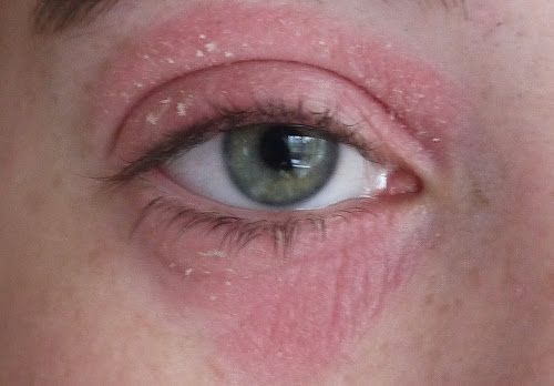 Les causes de la peau sèche autour des yeux et comment la soigner