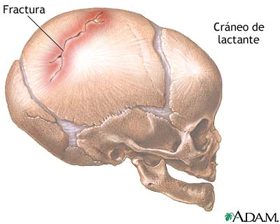 Tic2012: Principales lesiones cerebrales