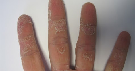 Kulit jari tangan kering