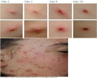 LP Varicella - Paduka.id