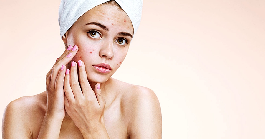 5 dúvidas mais comuns sobre a Acne!