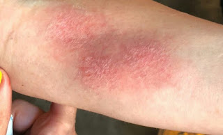 Ciri Ciri Ruam Kulit Pada Hiv - Ini Cirinya