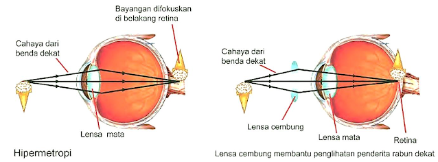 Rabun Dekat (Hipermetropi)